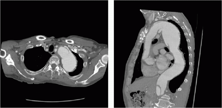 Acquired Disease of the Thoracic Aorta and Great Vessels | Radiology Key