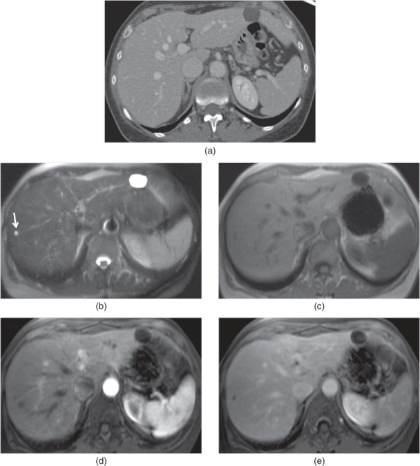 Cystic Diseases Of The Liver Radiology Key 2470