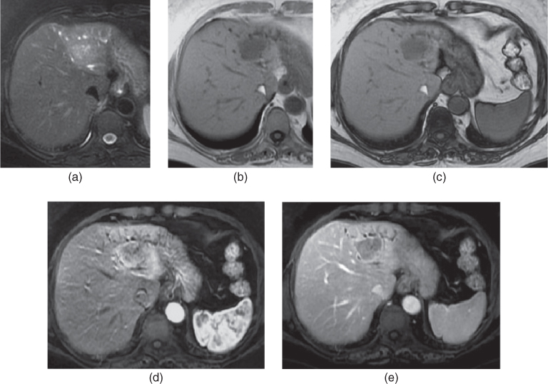 Liver Metastases Radiology Key