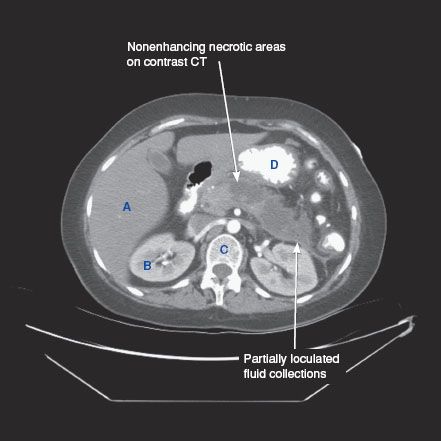 Pancreas | Radiology Key