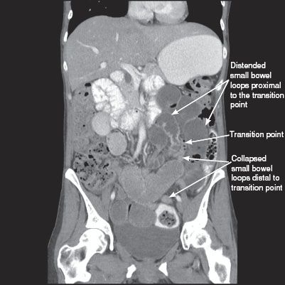 Small Bowel | Radiology Key