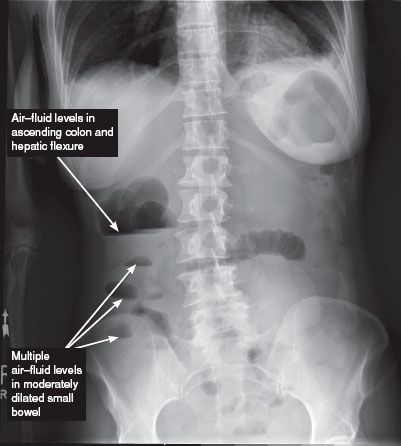 Small Bowel Radiology Key