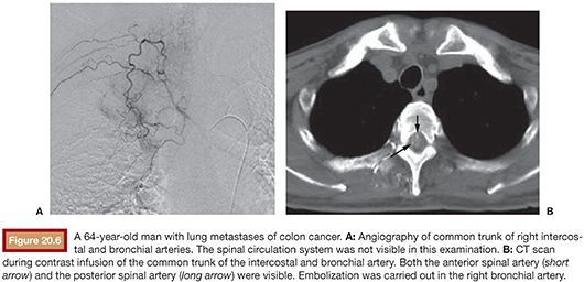 Varicocele Radiology Key