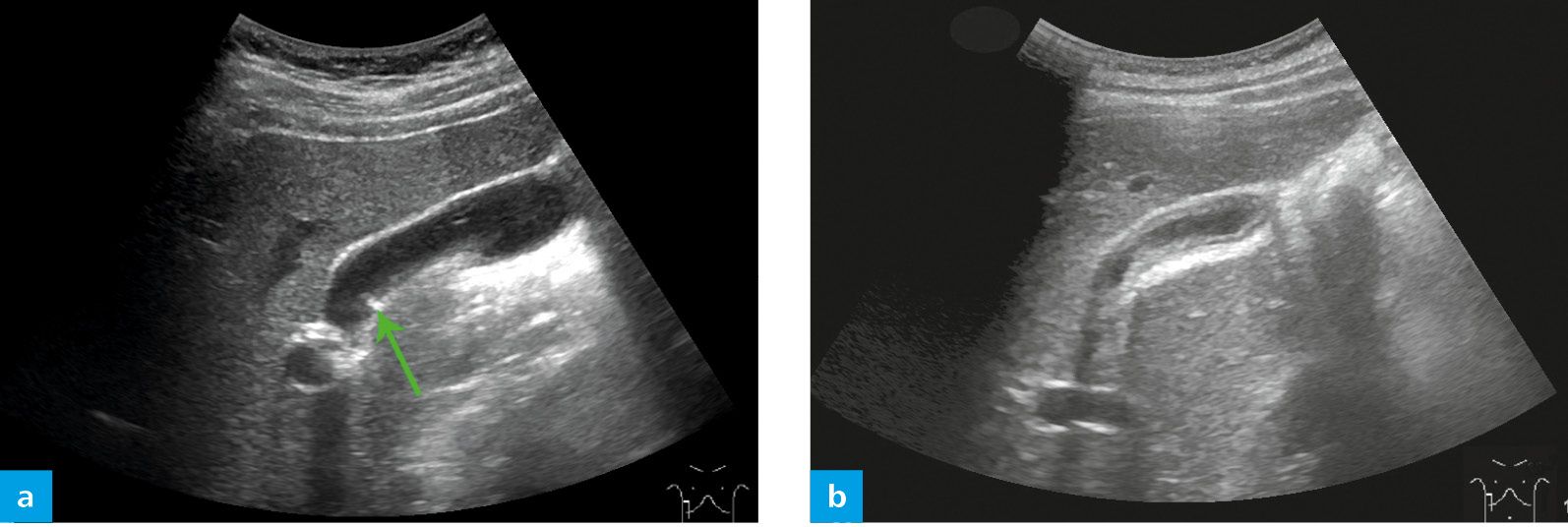 gallbladder-radiology-key