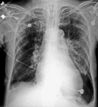 lung barotrauma
