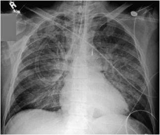 cephalization of pulmonary vessels