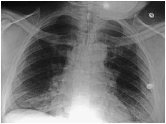 10: ATELECTASIS AND COLLAPSE | Radiology Key