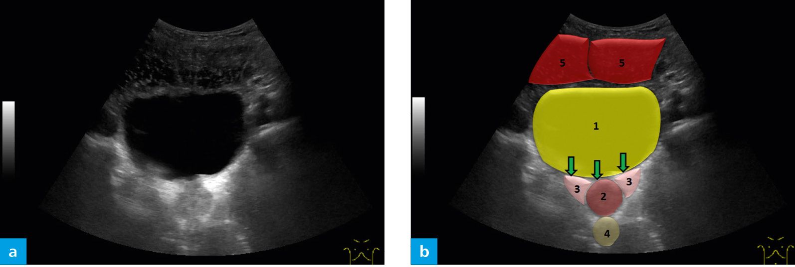 A) A B-mode ultrasound image of a bladder in a transverse section