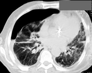 pulmonary barotrauma interventuons