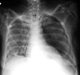 incidence of pulmonary barotrauma in a medical icu