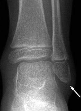 The Foot and Ankle: Congenital and Developmental Conditions | Radiology Key