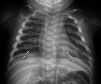 displaced rib fracture