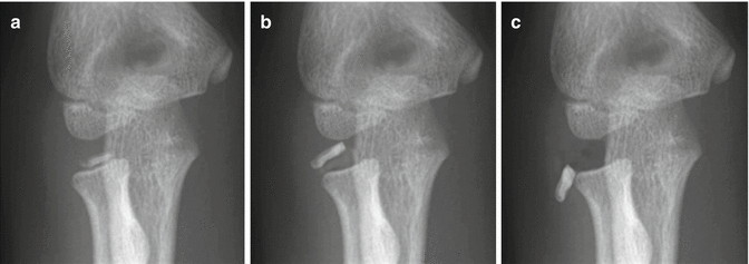 cpt code for orif radial head fracture