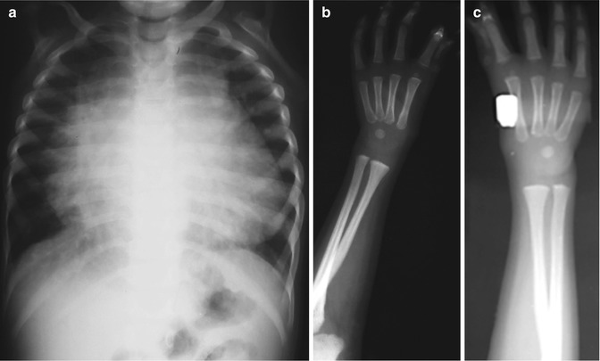 The Hand And Wrist Congenital And Developmental Conditions Radiology Key