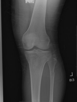 closed fracture of distal end of right fibula