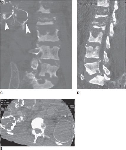 Metabolic Bone Diseases | Radiology Key