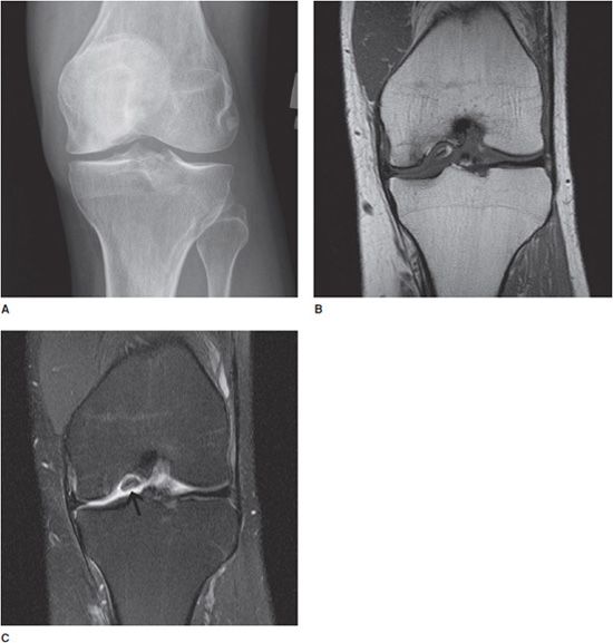 osteochondrosis 1 2 nyaki)