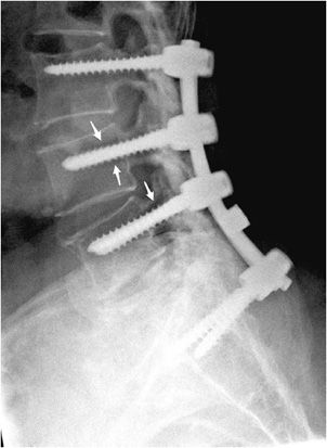 hardware screws pedicle orthopedic loose screw lumbar fusion loosening spine lucency s1 rods l3 radiology posterior complications lateral radiograph l5