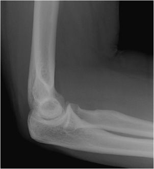 olecranon bursitis xray