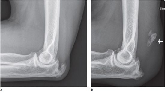 Olecranon Bursitis Xray