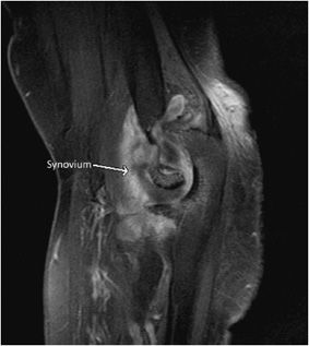 olecranon bursitis mri