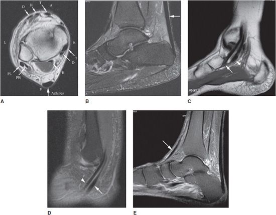 Ankle MRI Radiology Key