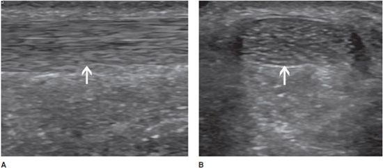 echogenic ultrasound