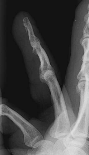 Hand | Radiology Key