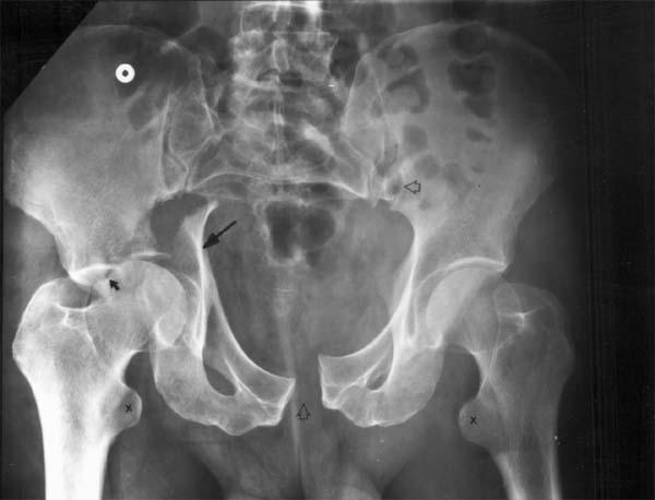 Pelvic ring injuries: classification and treatment - ScienceDirect