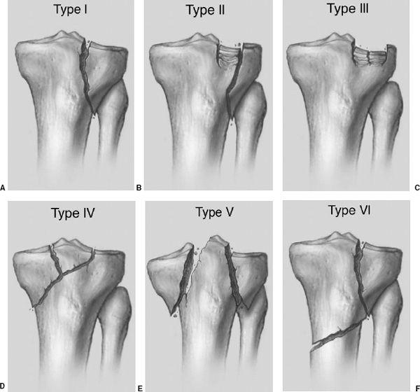 Tibial Condyle/Plateau Fractures.