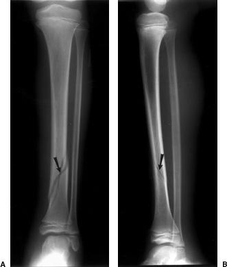 Spiral Fracture: Healing Time, Tibia, and Fibula