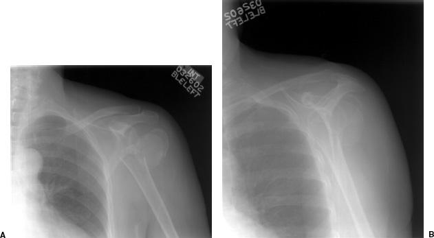 Humerus, Radiology Reference Article
