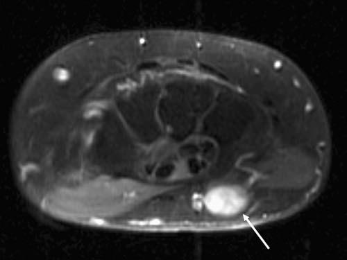 The Carpal Tunnel And Guyon’s Canal | Radiology Key