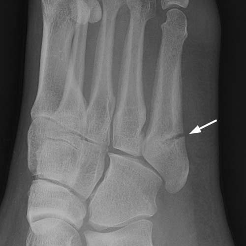 metatarsal fracture fragment 3 mm displaced