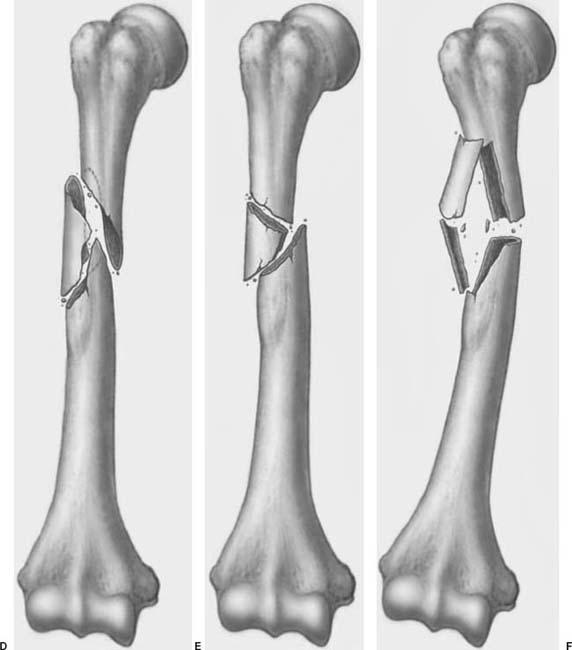 Humeral Fracture Classification
