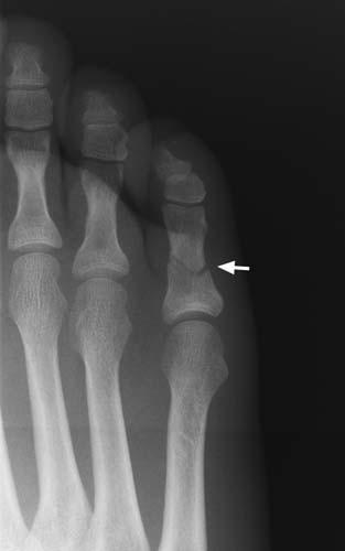 non displaced toe fracture