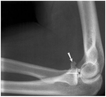 The Elbow | Radiology Key