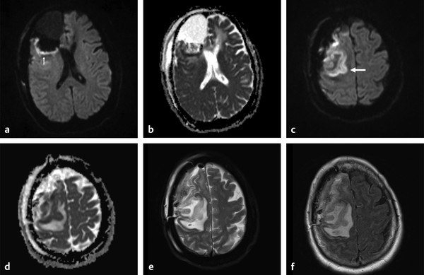 Brain Edema: Pathophysiology | Radiology Key