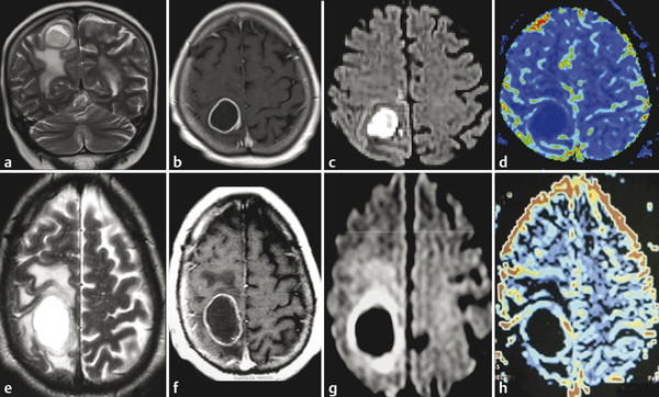 diffusion-weighted-imaging-in-the-evaluation-of-brain-tumors