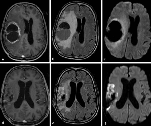 diffusion-weighted-imaging-in-the-evaluation-of-brain-tumors