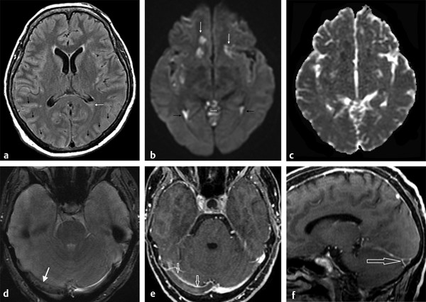 Diffusion Weighted and Diffusion Tensor Imaging in Infectious Diseases ...