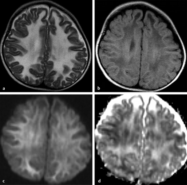 Diffusion Weighted Imaging and Diffusion Tensor Imaging of White Matter ...
