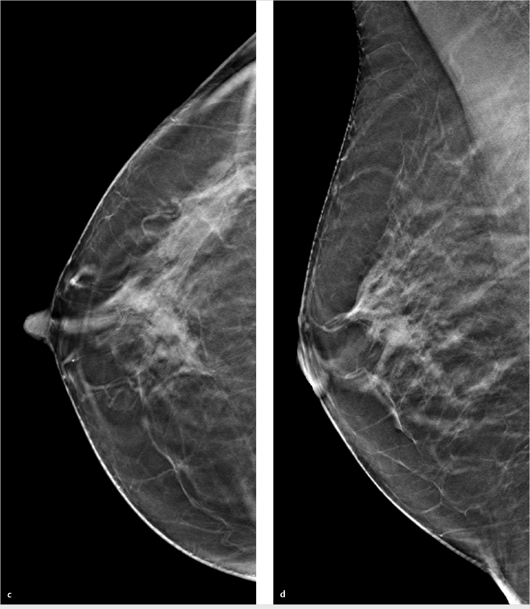 Mammogram atypical mass large breasts Illustrative Case Reports Radiology Key