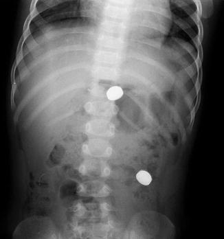 Imaging Of Gastrointestinal Tract Perforation In The Pediatric Patient ...