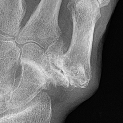 Noninflammatory Joint Disease | Radiology Key