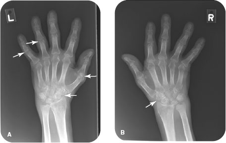 osteoarthritis hand xray