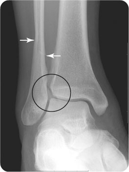 spiral fracture x ray