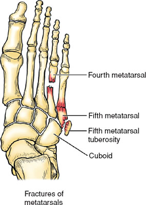 distal metatarsal fracture