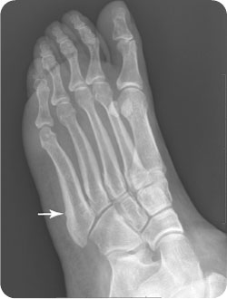 base of fifth metatarsal fracture