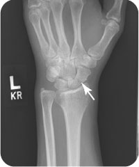 Scaphoid Fractures | Radiology Key